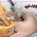 لاپاراسکوپی