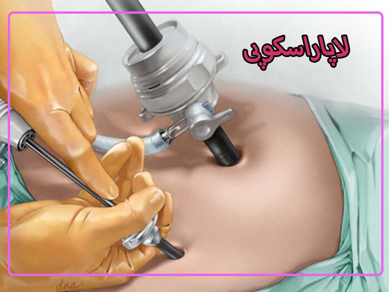 لاپاراسکوپی
