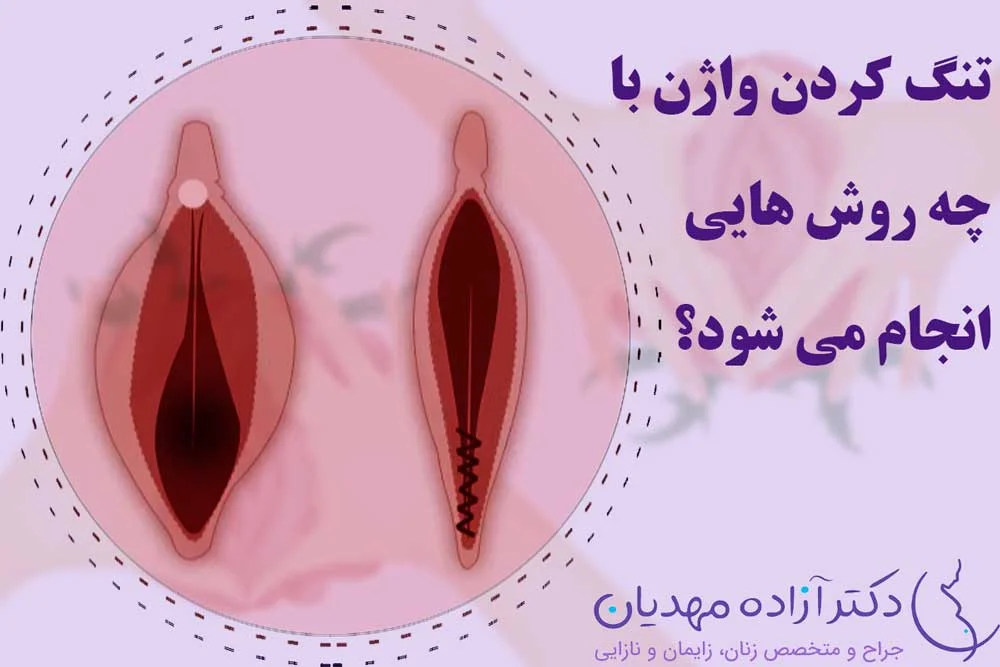 راه های تنگ کردن واژن