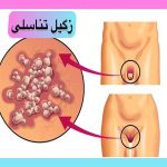 زگیل-تناسلی