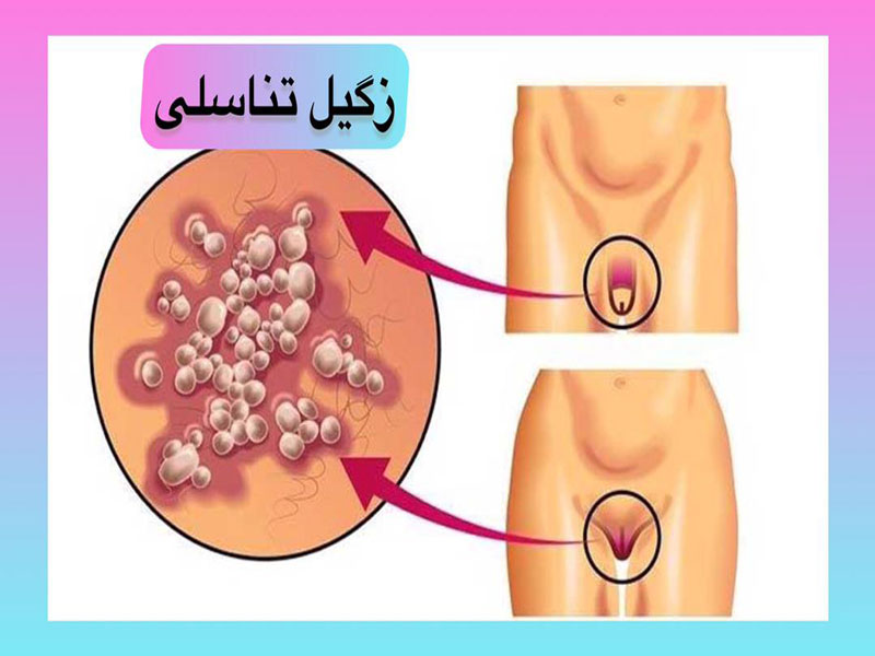 زگیل-تناسلی