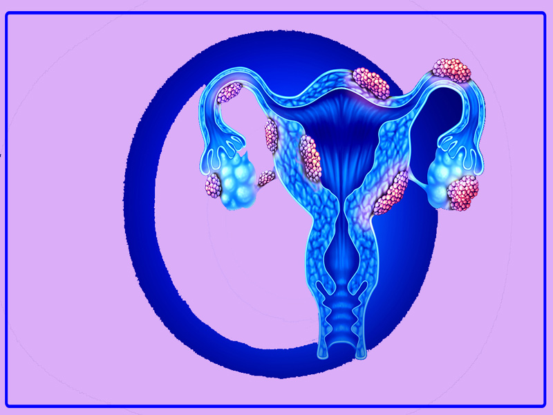 اندومتریوز