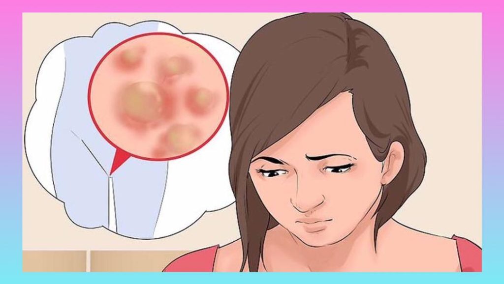 درمان زگیل تناسلی