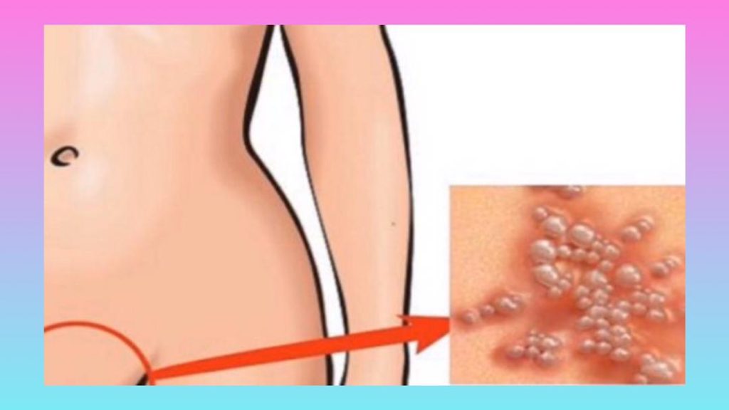 زگیل تناسلی