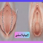 لابیاپلاستی