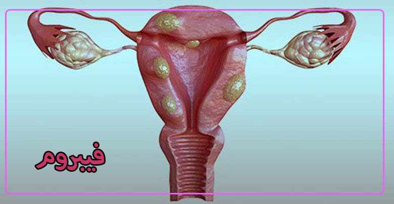 فیبروم رحم