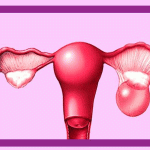 کیست تخمدان