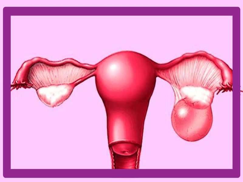 کیست تخمدان