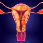 endometrial-cancer