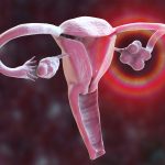 تشخیص تنبلی تخمدان