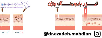 لیزر بلیچینگ واژن