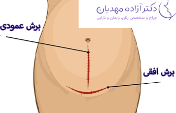 برش بخیه سزارین